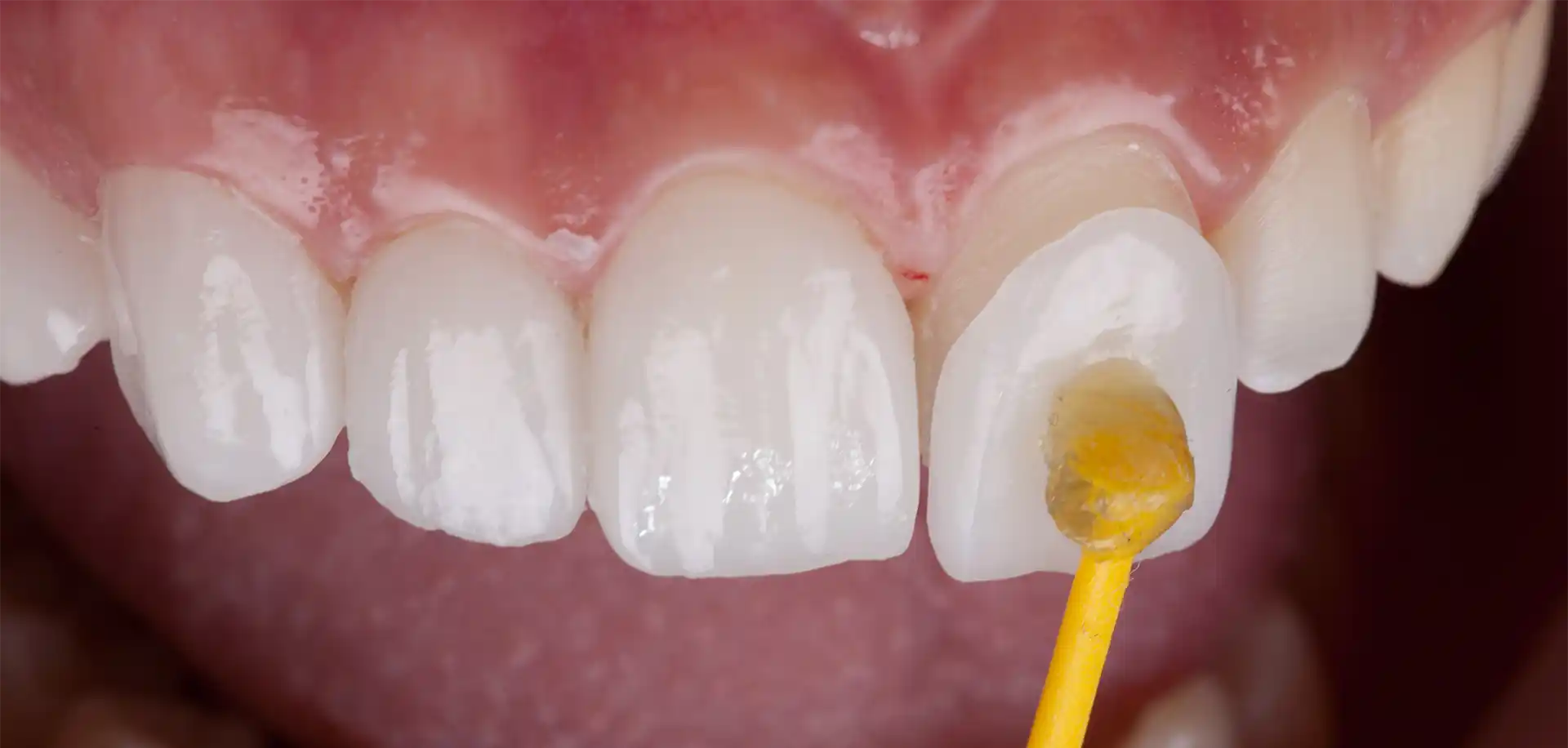 Faccette dentali