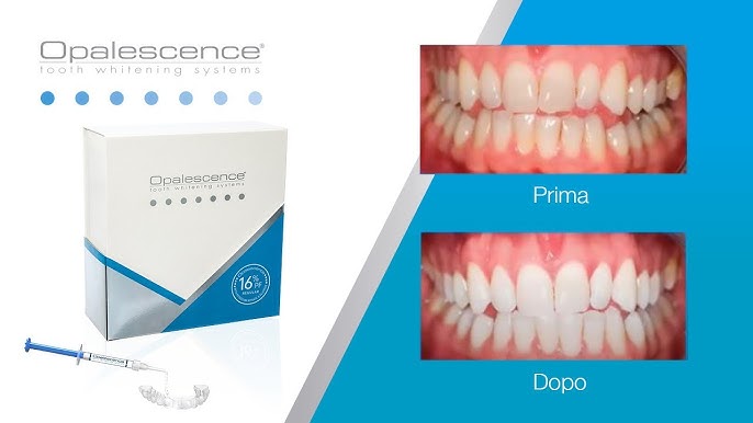 Sbiancamenti dentali